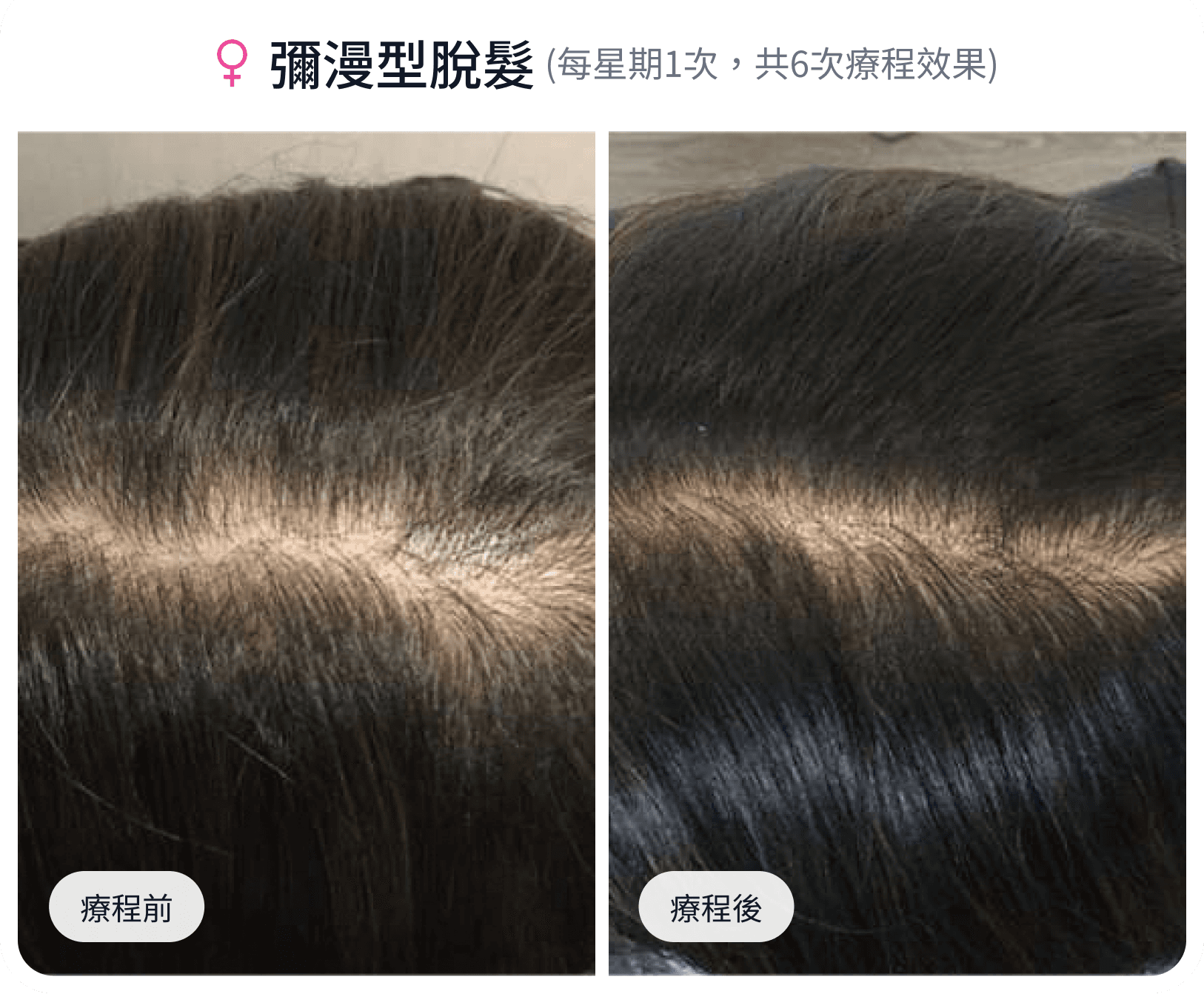 彌漫型脫髮