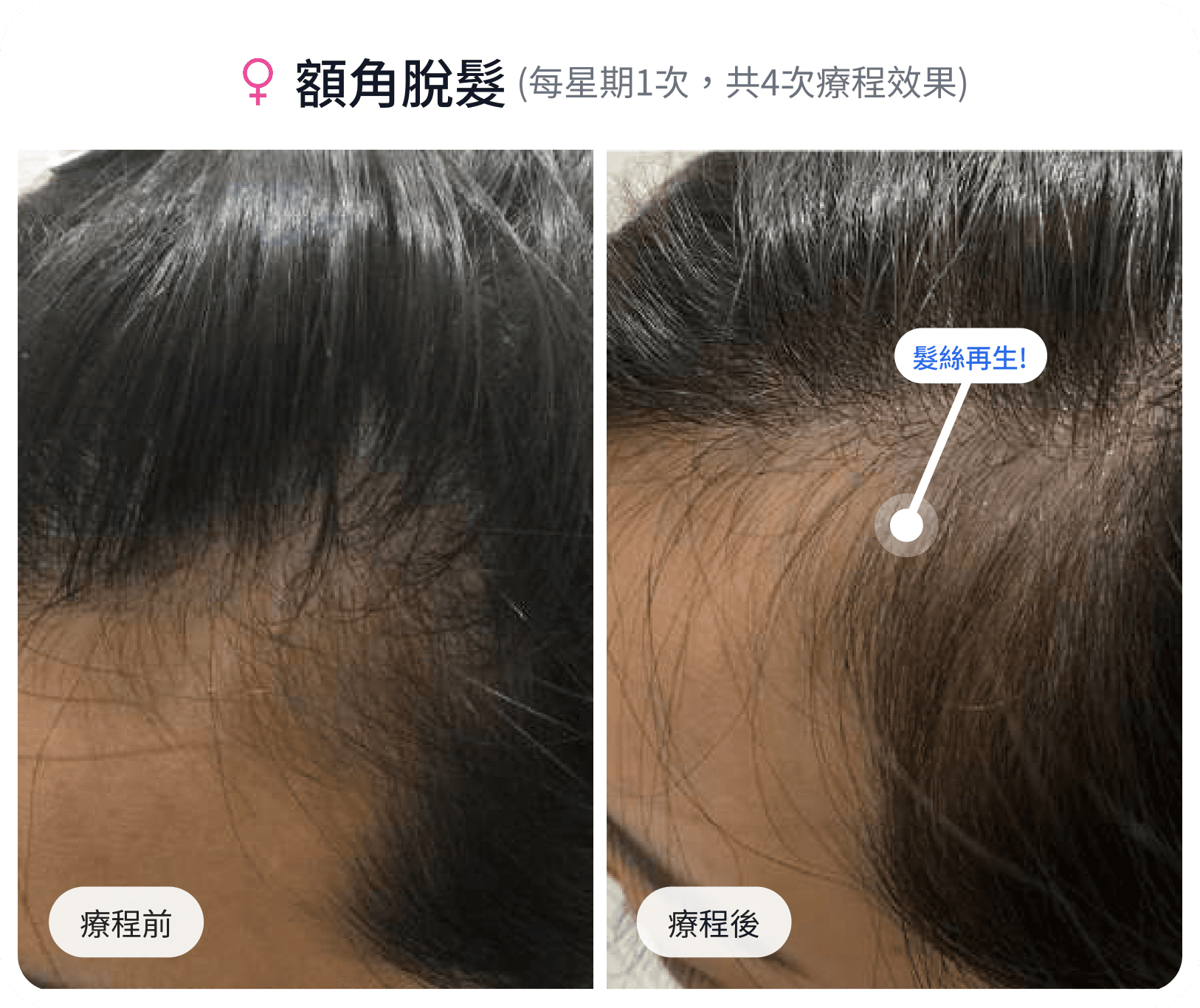額角脫髮