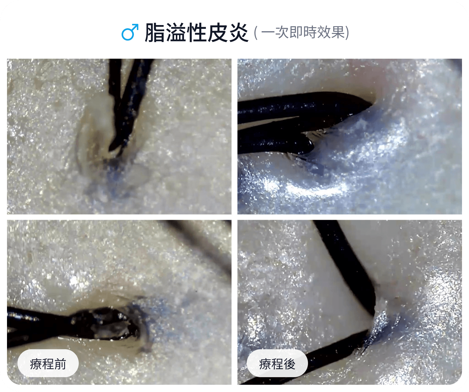 脂溢性皮炎